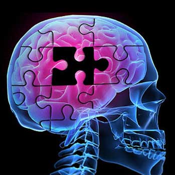 Alzheimer's Disease - Version 2.0