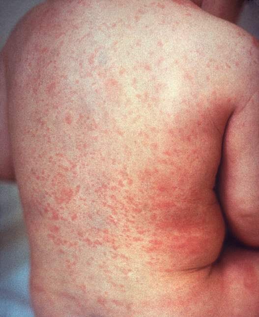 Rubella (german measles) Version 1.1