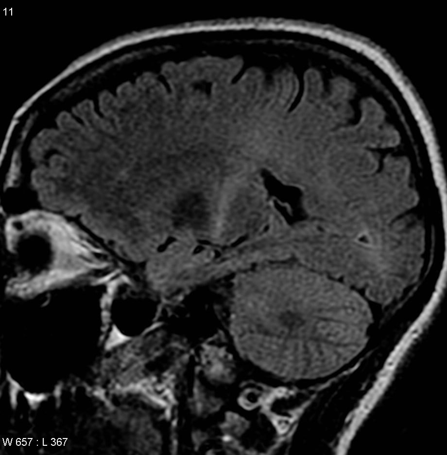 ALS (amyotrophic lateral sclerosis) Version 2.0